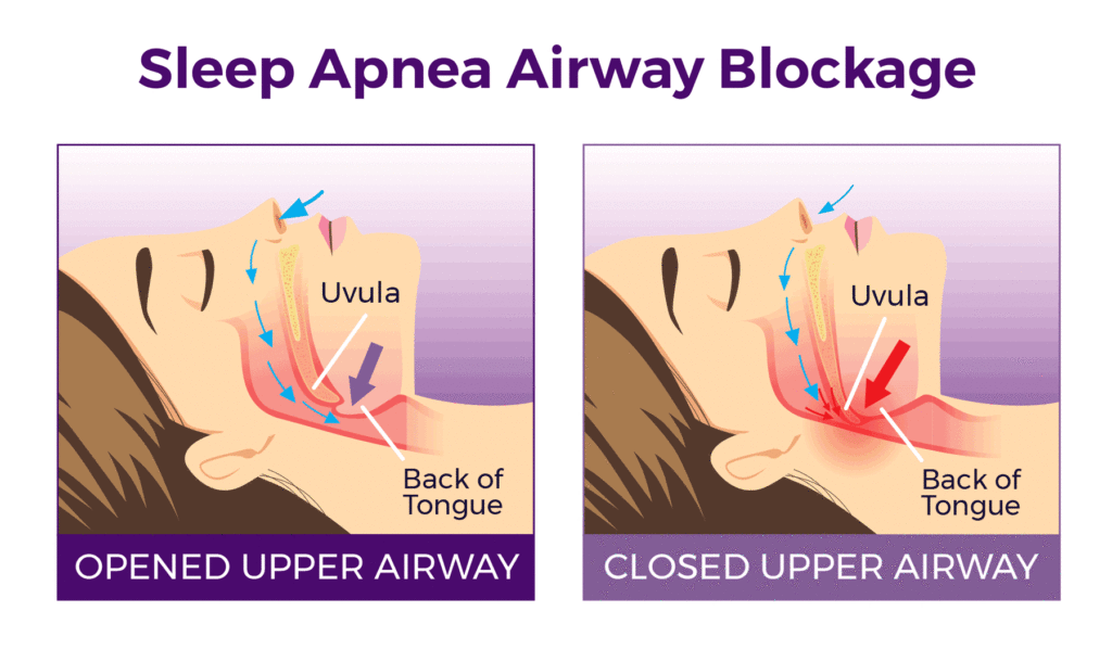 cpap-therapy-cpap